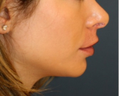 Feel Beautiful - Chin Implant 201 - Before Photo